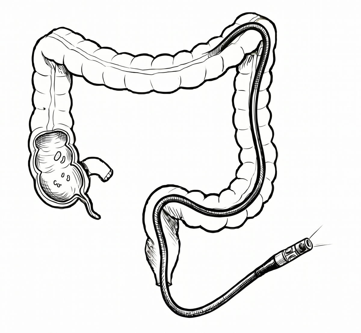 Colonoscopy