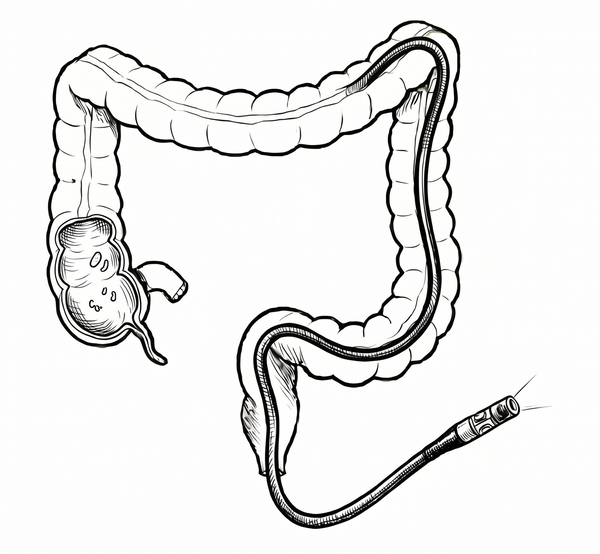 Colonoscopy